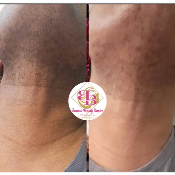 Acne and pimple Treatment Face Cream 50g - Image 7