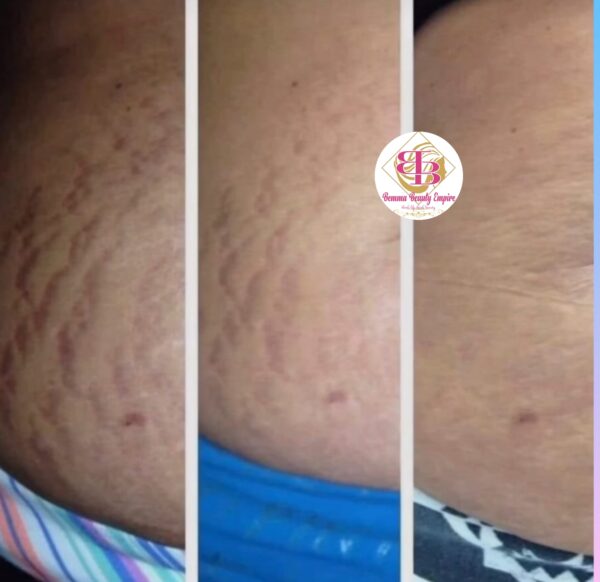 Stretch marks 3n1 set. Oil+soap +scrub - Image 9