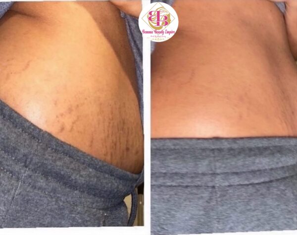 Stretch marks 3n1 set. Oil+soap +scrub - Image 10