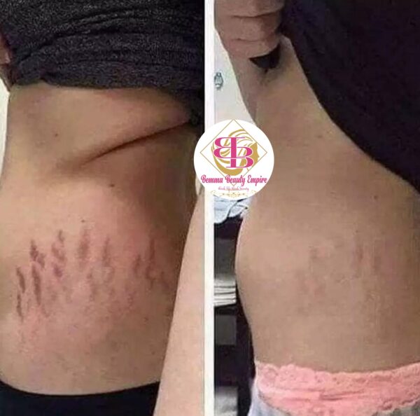 Stretch marks 3n1 set. Oil+soap +scrub - Image 8