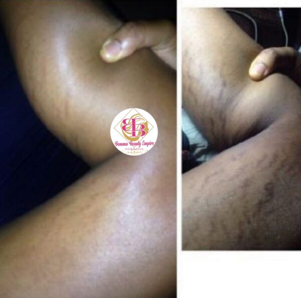 Stretch marks 3n1 set. Oil+soap +scrub - Image 11